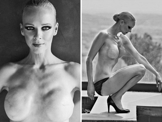 Μοντέλο φωτογραφήθηκε γυμνή μετά από διπλή μαστεκτομή!