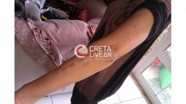 ΣΟΚ στην Κρήτη: Πήγε για αποτρίχωση και έφυγε με εγκαύματα