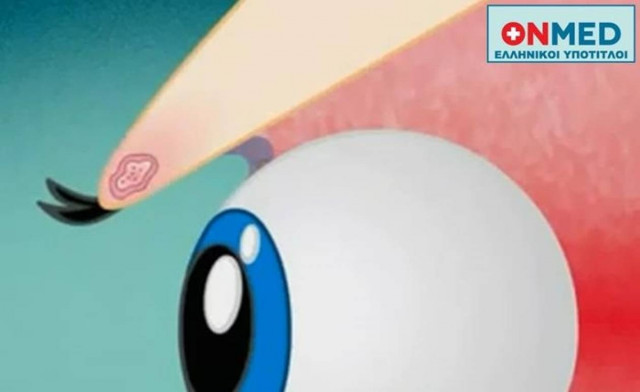 Γιατί εμφανίζεται το κριθαράκι στο μάτι (βίντεο)