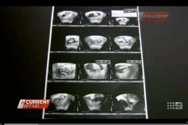 «Πάγωσε» όταν οι γιατροί της είπαν ότι κυοφορεί μωρό που έχει...