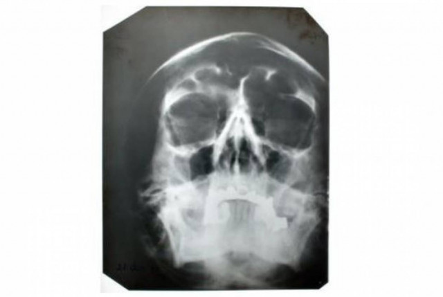 Πόσα πλήρωσαν για μία ακτινογραφία του κρανίου του...Χίτλερ
