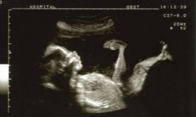 Μεγ. Βρετανία: Νόμος για την απαγόρευση αμβλώσεων σε θηλυκά έμβρυα