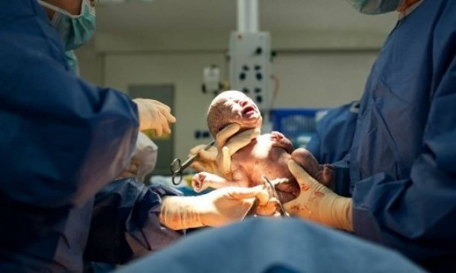 Ανάρρωση μετά την καισαρική τομή- Όλα όσα πρέπει να γνωρίζετε