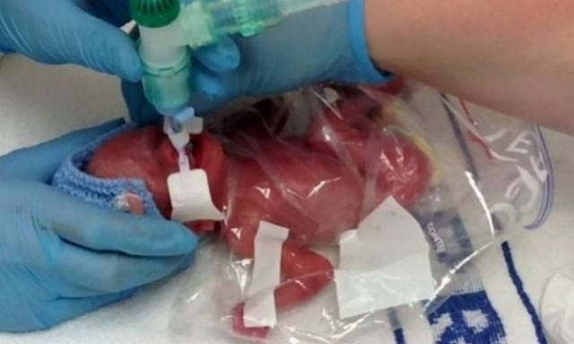 Έσωσαν τη ζωή σε ένα μωρό 450γρ. με ένα... σακουλάκι τροφίμων!