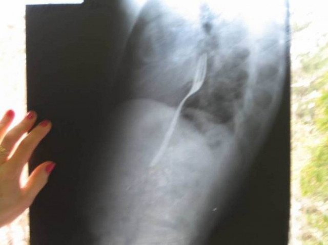 Το πιο ανόητο στοίχημα: Μεθυσμένος δεν θυμόταν ότι κατάπιε ένα...