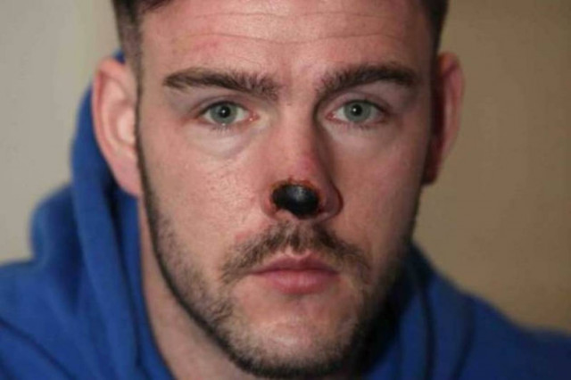 Τον δάγκωσαν στο δρόμο, κόβοντας κομμάτι από τη μύτη του! (photo)