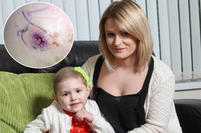 Kουνούπι διέγνωσε τον καρκίνο τρίχρονης! (photos)