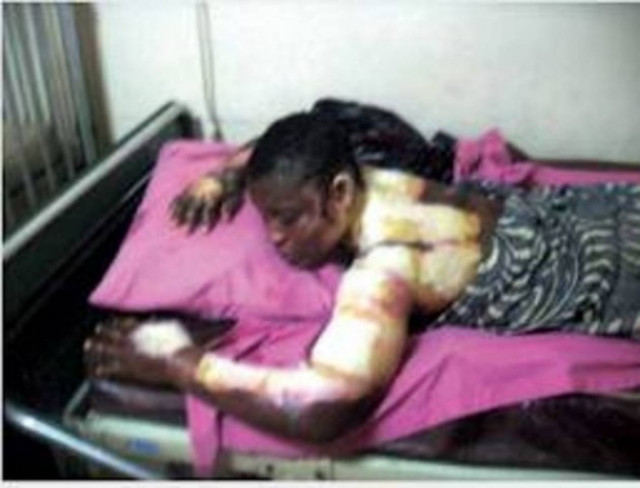 Έκαψε την έγκυο γυναίκα του γιατί τα πεθερικά του δεν του έδιναν προίκα (pic)