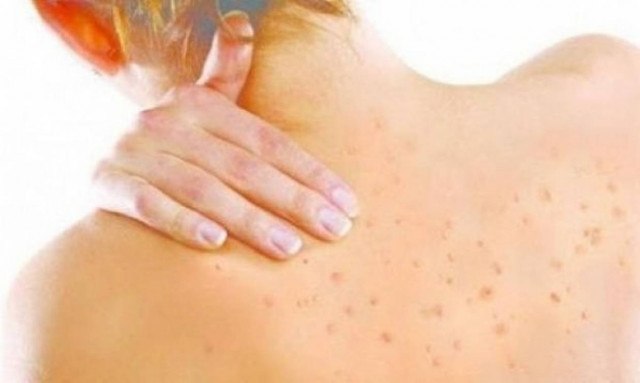 Σπυράκια στην πλάτη! Εξαφάνισέ τα με...