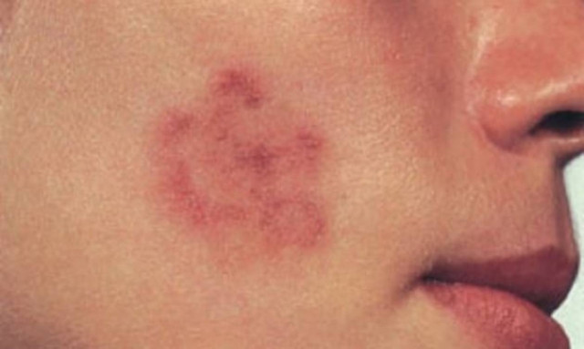 Έκζεμα: ασπίδα κατά του μελανώματος!