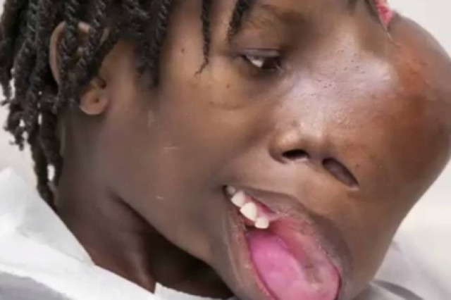 Βίντεο που σοκάρει: Ζούσε με έναν τεράστιο όγκο 2 κιλών στο πρόσωπο