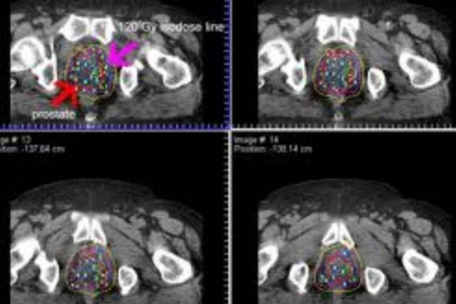 Ο καρκίνος του προστάτη μπορεί να σεξουαλικά μεταδιδόμενος!