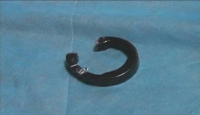 Ηλικιωμένος έβαλε δαχτυλίδι στο πέος του από περιέργεια και...