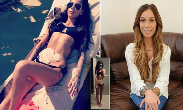 Μοντέλο φωτογραφήθηκε στο facebook με κολοστομία! (pics)