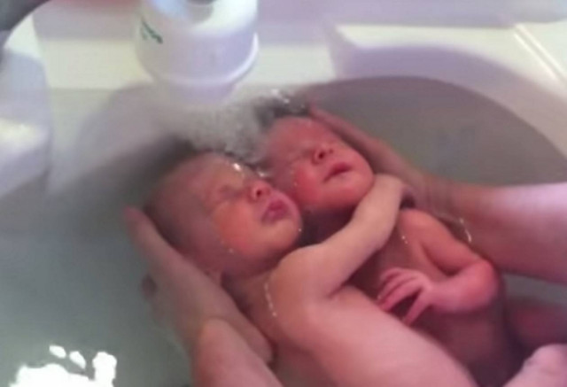 Το θαύμα της ζωής: Δίδυμα γεννήθηκαν αγκαλιασμένα – Φανταστικό βίντεο