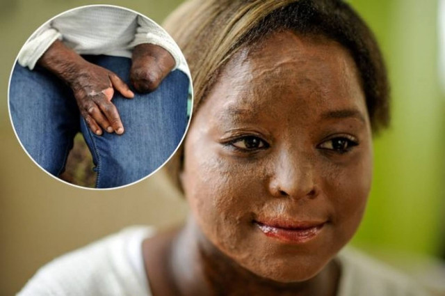 Συγχώρεσε τη γυναίκα που την έκαψε και της στέρησε τα χέρια της! (pics)