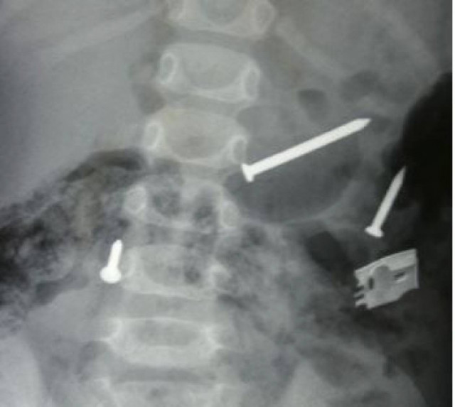 Πάτρα: Είχε καταπιεί ρολόι, κοσμήματα, βίδες