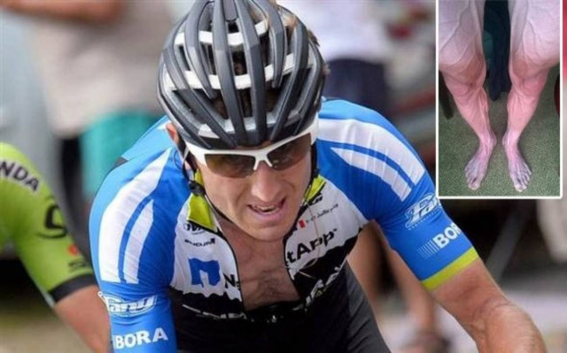 Σάλος: Έτσι είναι τα πόδια ενός ποδηλάτη μετά το Γύρο της Γαλλίας