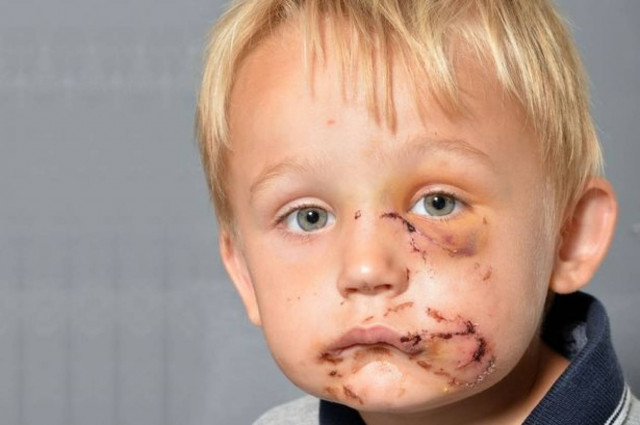 Φρίκη! Σκύλος επιτέθηκε σε παιδί (σκληρές εικόνες)