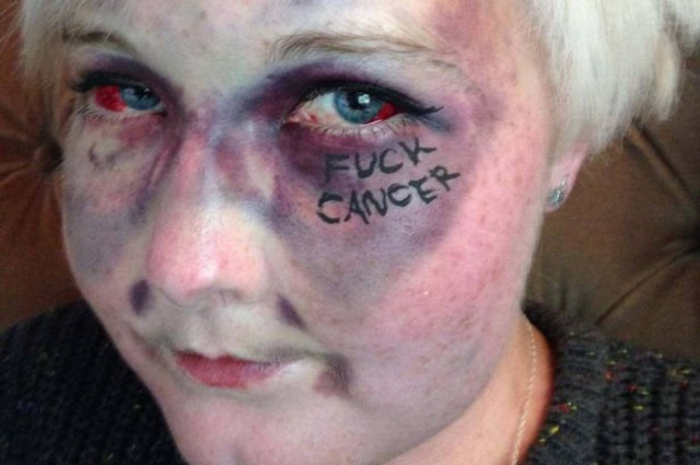 Βρετανία: Οι σοκαριστικές selfies – μήνυμα κατά του καρκίνου! (photos)