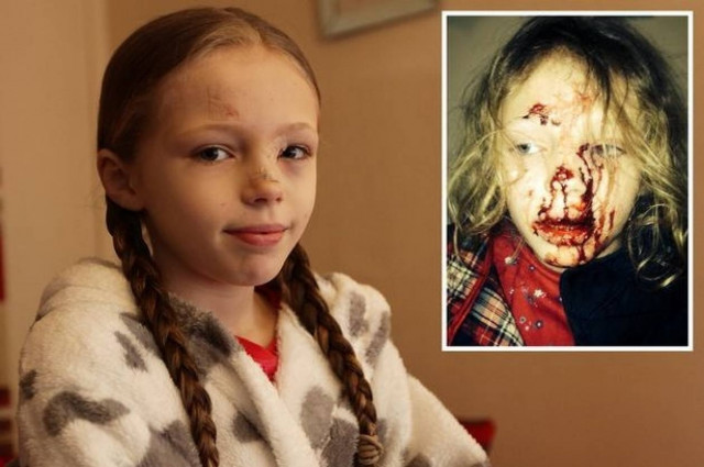 Τα απίστευτα σημάδια που άφησε ασυνείδητος οδηγός σε 9χρονη! (σκληρές εικόνες)