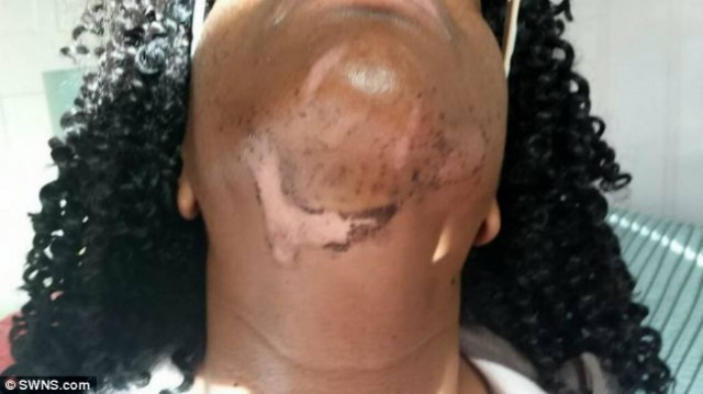 Σημαδεύτηκε για μια ζωή μετά από αποτρίχωση! (σκληρές εικόνες)