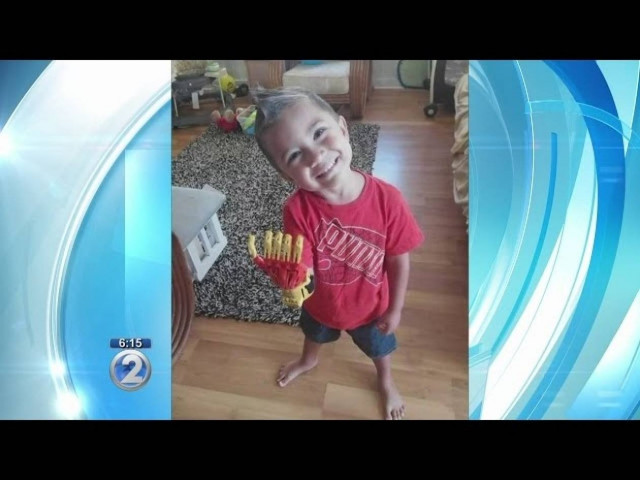 Αγόρι που γεννήθηκε χωρίς δάχτυλα, αποκτά το χέρι του Iron man (pics+video)