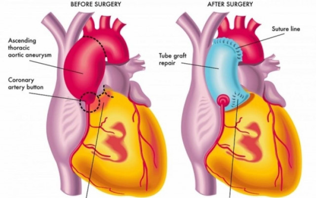 Τα συμπτώματα που «μαρτυρούν» ανεύρυσμα και τα είδη του