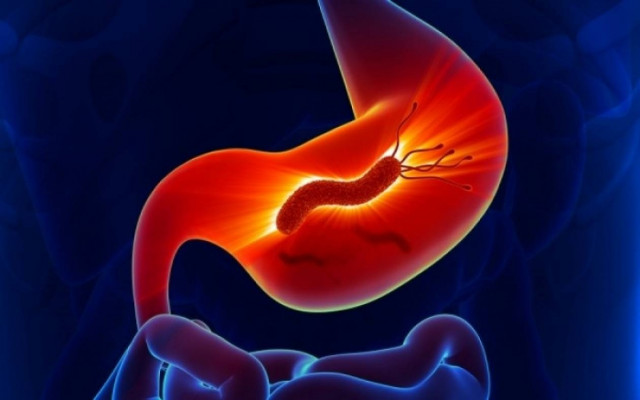 Πότε το έλκος στομάχου μπορεί να μετατραπεί σε καρκίνο