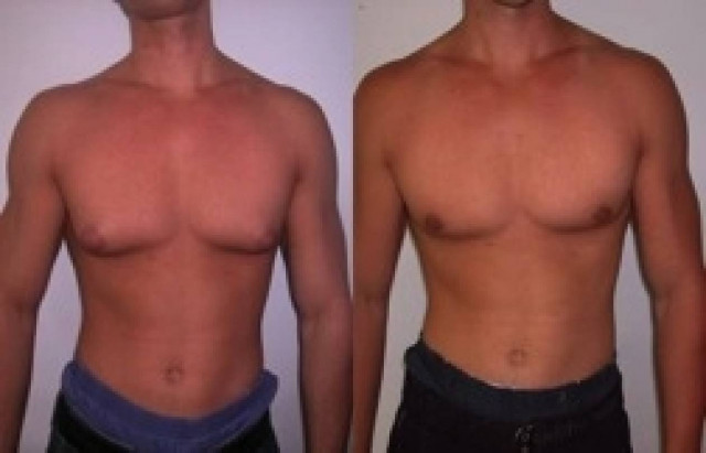 Γυναικομαστία: Ένα αγόρι με στήθος έφηβης κοπέλας εξομολογείται