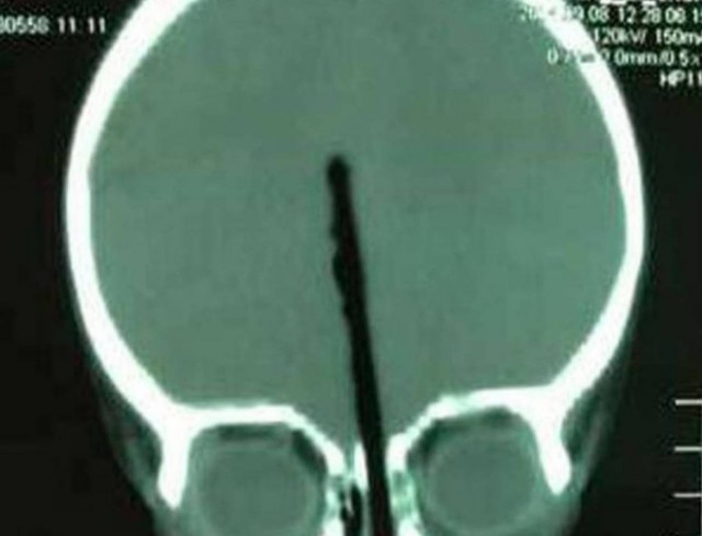 Φρίκη: Αγοράκι 2 ετών έβαλε ολόκληρο... τσόπστικ στη μύτη του