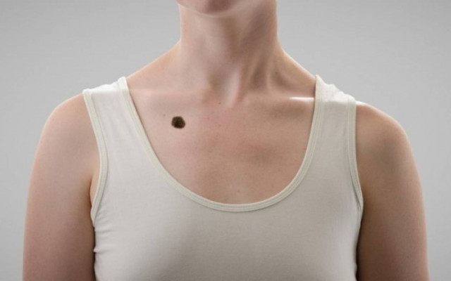 Καρκίνος του δέρματος: 20 φωτογραφίες που σώζουν ζωές