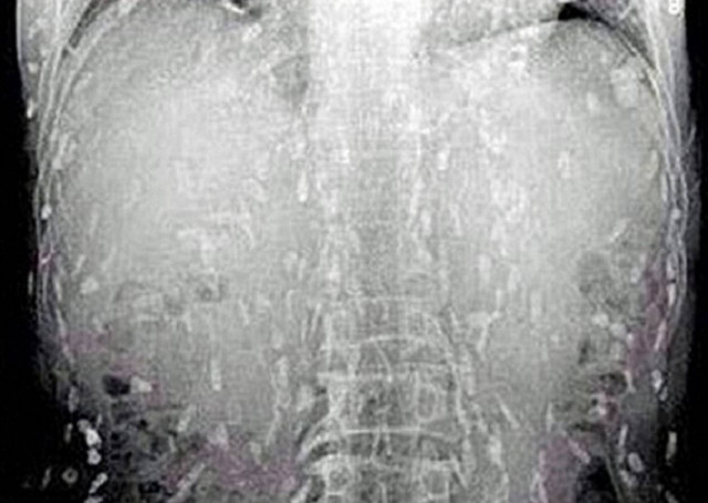 Κίνα: Έφαγε χαλασμένο σούσι και γέμισε το σώμα του παράσιτα! (pics)