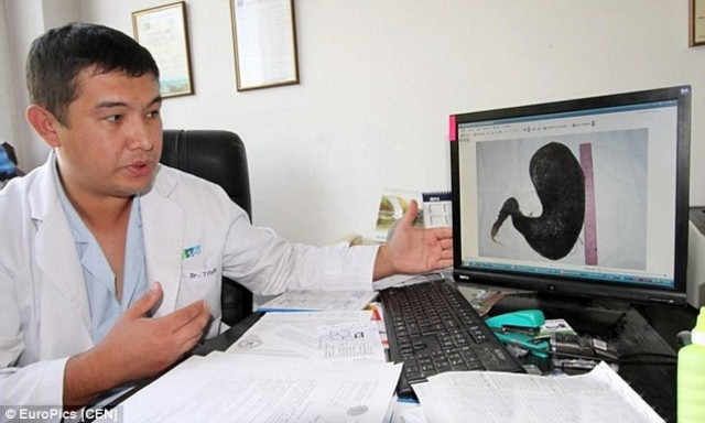 Δείτε τι βρήκαν μέσα σε μια 18χρονη κοπέλα - Παραλίγο να πεθάνει