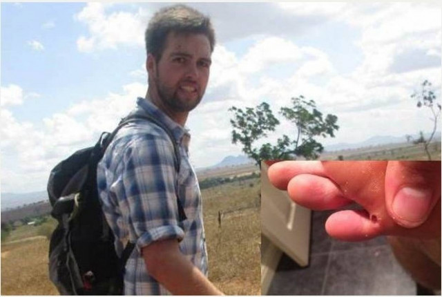 Πήγε ταξίδι και έφερε 100... αυγά εντόμων στο πόδι του! (σκληρές εικόνες)