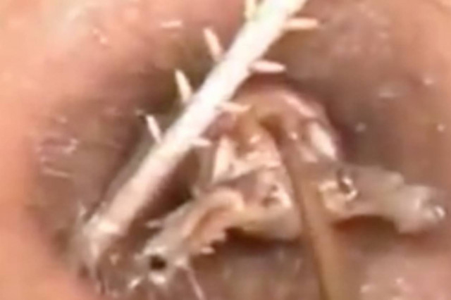 Ινδία: Δείτε τι ανατριχιαστικό πλάσμα μεγάλωνε στο αυτί του! (vid+pics)