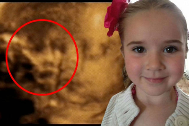 Βίντεο: Είδαν στο υπερηχογράφημα τον «φύλακα-άγγελο» του παιδιού τους