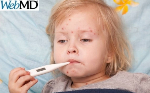 Ιλαρά: Αίτια, συμπτώματα και αντιμετώπιση