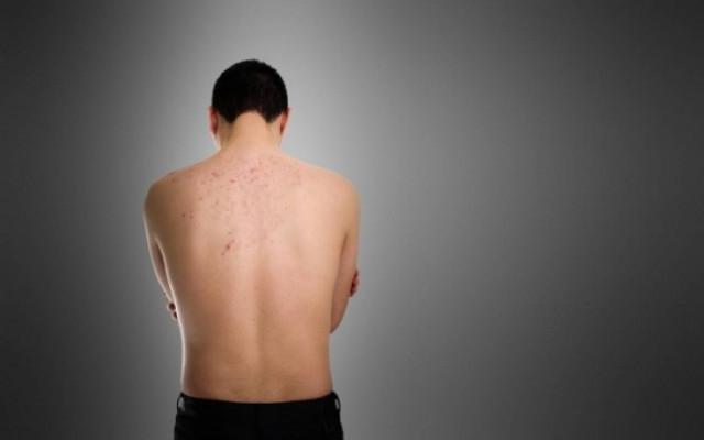 Ατοπική δερματίτιδα: Τι είναι, πού εμφανίζεται και ποια είναι τα συμπτώματα