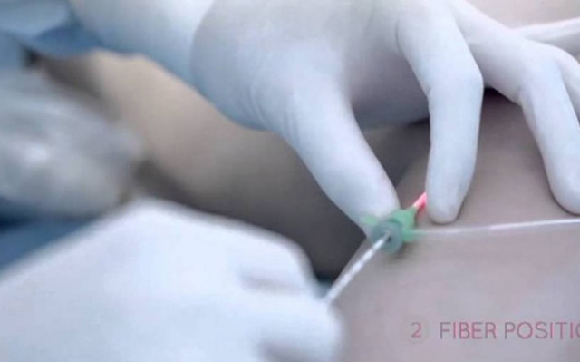 Κιρσοί και θεραπεία με Laser