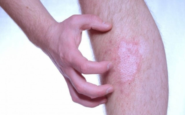 Πέντε παράγοντες που προκαλούν έξαρση στην ψωρίαση