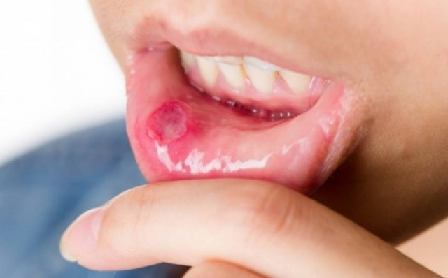 Πώς να αντιμετωπίσετε τις άφτρες στο στόμα