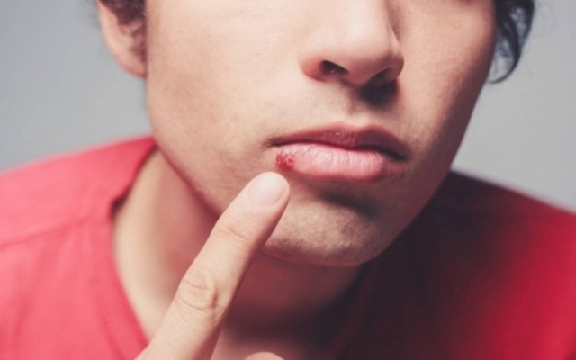 Επιχείλιος έρπης: Η άγνωστη σχέση του με το στρες