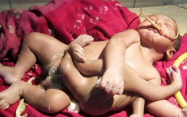 Ινδία: Βρέφος γεννήθηκε με 8 άκρα και λατρεύεται σαν Θεός!