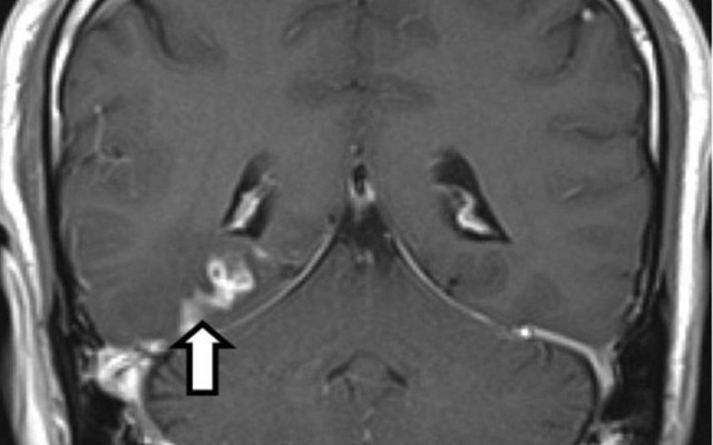 Παράσιτο ζούσε στον εγκέφαλο ανθρώπου τέσσερα χρόνια (pics)