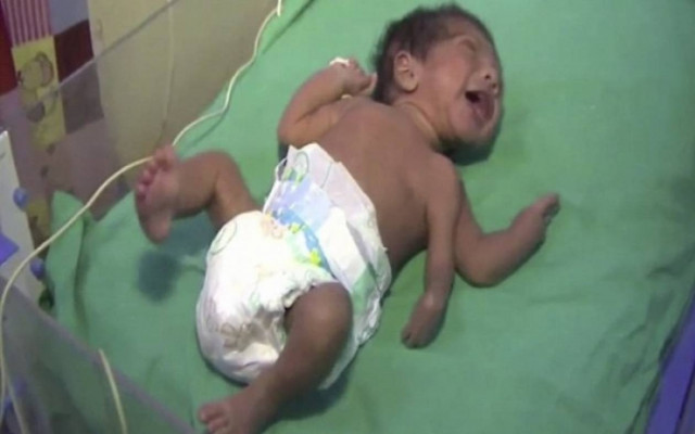 Μωρό με τρία χέρια υποβλήθηκε σε σωτήρια επέμβαση