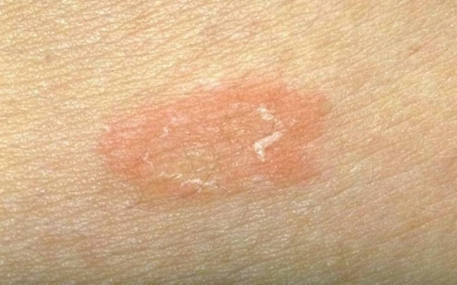 Ροδόχρους πιτυρίαση: Τι είναι και πώς θα την αντιμετωπίσετε