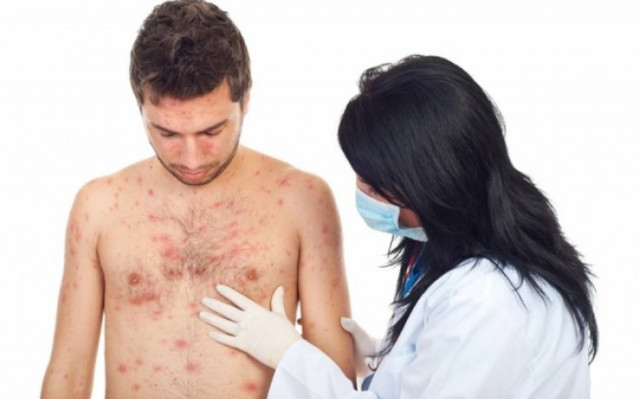 Ανεμοβλογιά στους ενήλικες: Γιατί είναι επικίνδυνη