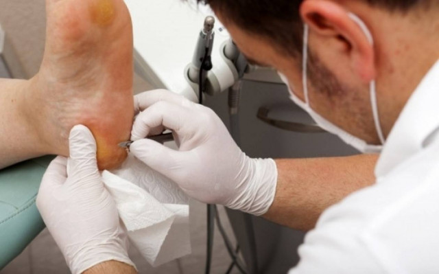 Πώς μπορείτε να απαλλαγείτε από τους κάλους