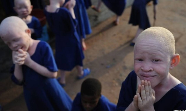 Τανζανία: Σύλληψη επτά υπόπτων για ακρωτηριασμό αλμπίνου